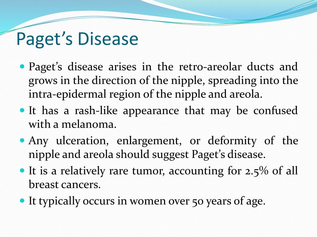 Paget’s Disease