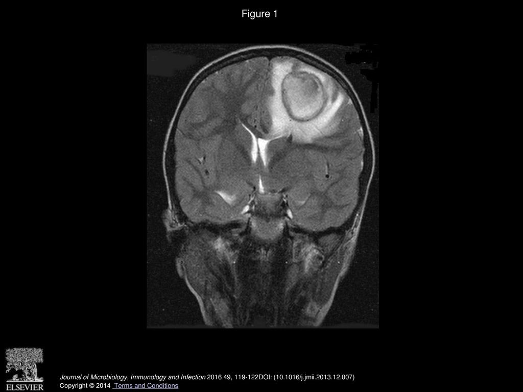 Aggregatibacter aphrophilus brain abscess secondary to primary tooth  extraction: Case report and literature review Sofia Maraki, Ioannis S.  Papadakis, - ppt download