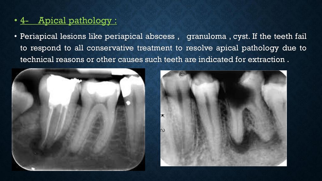 Oral Surgery Exodontia - ppt download