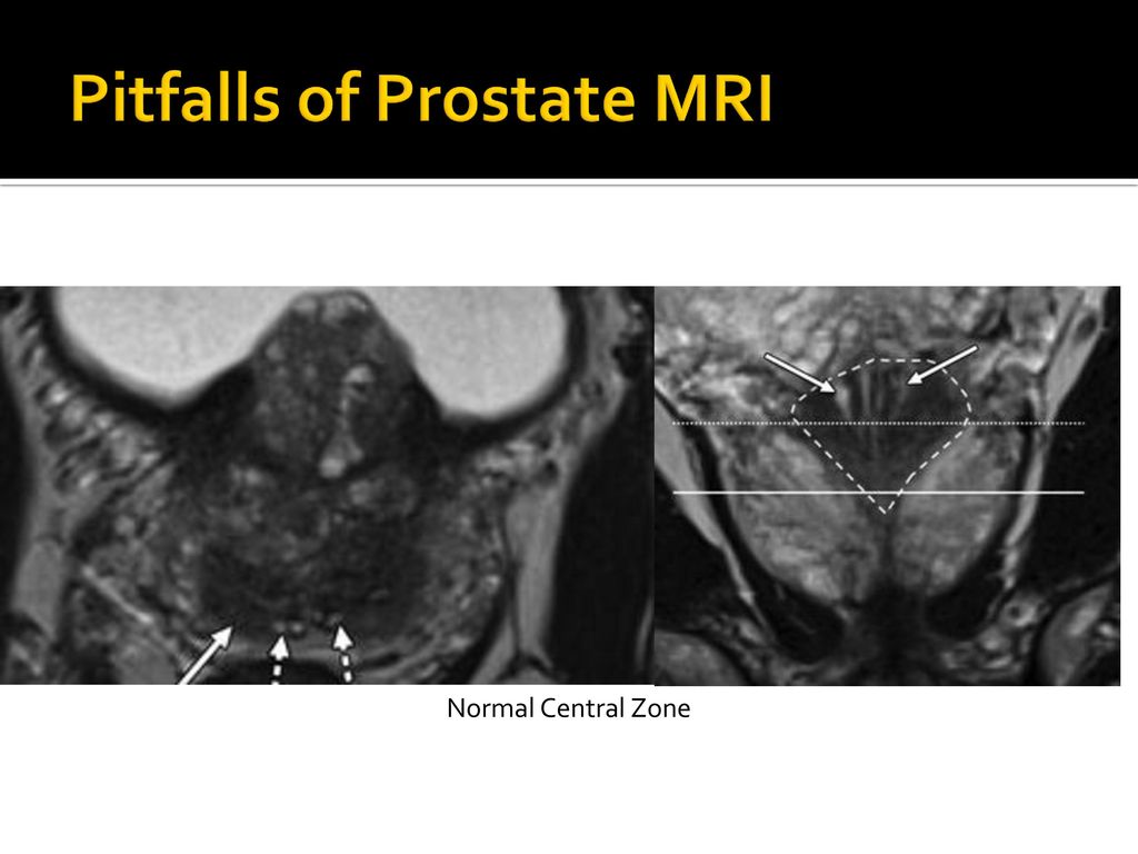 MRI of the Prostate