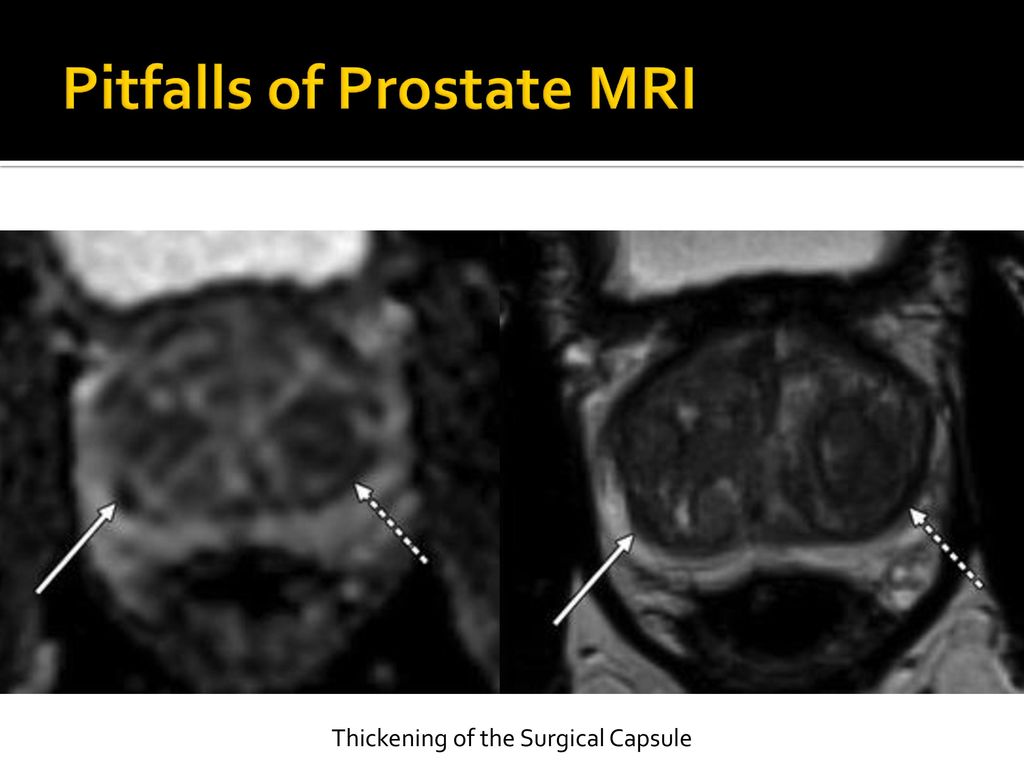 pitfalls prostate mri radiographics