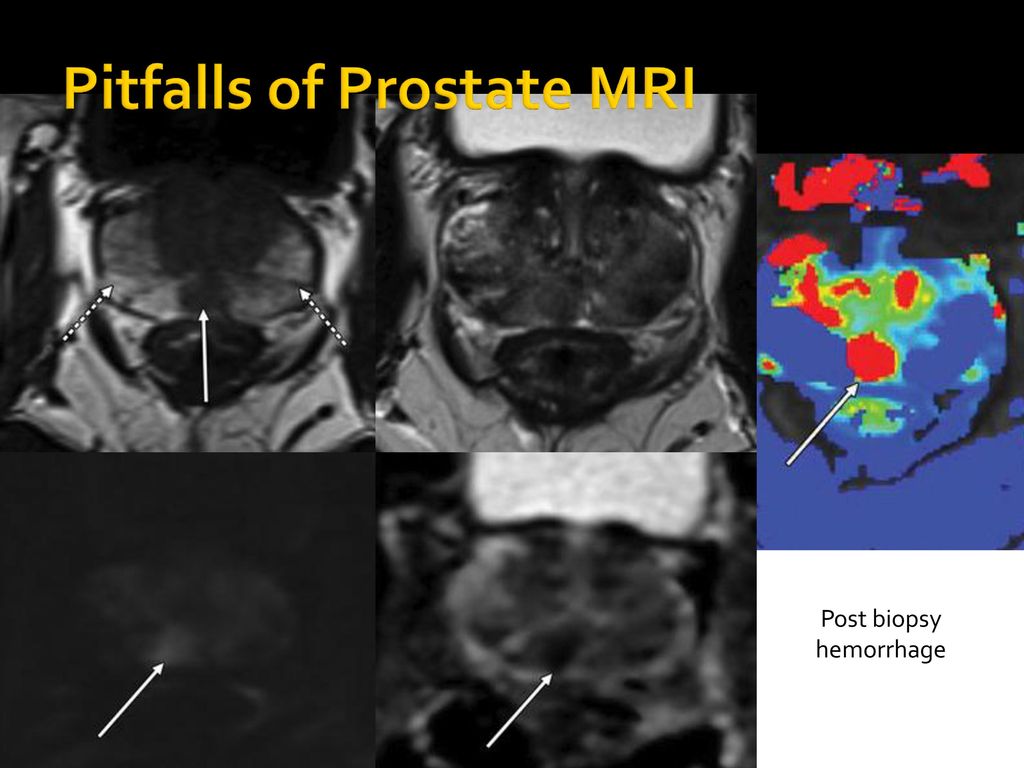 pitfalls prostate mri radiographics prosztata hajhullás