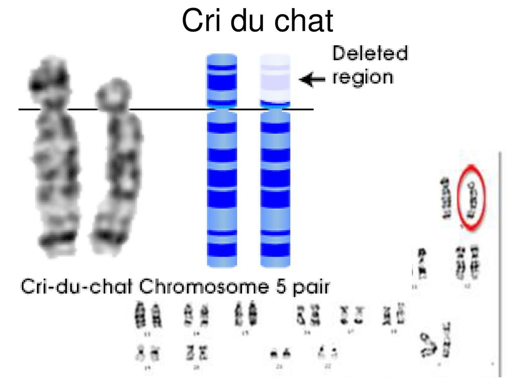 Мужская хромосома 5. 5 Хромосома. Короткое плечо 5 хромосомы. Делеция плеча 5 хромосомы.