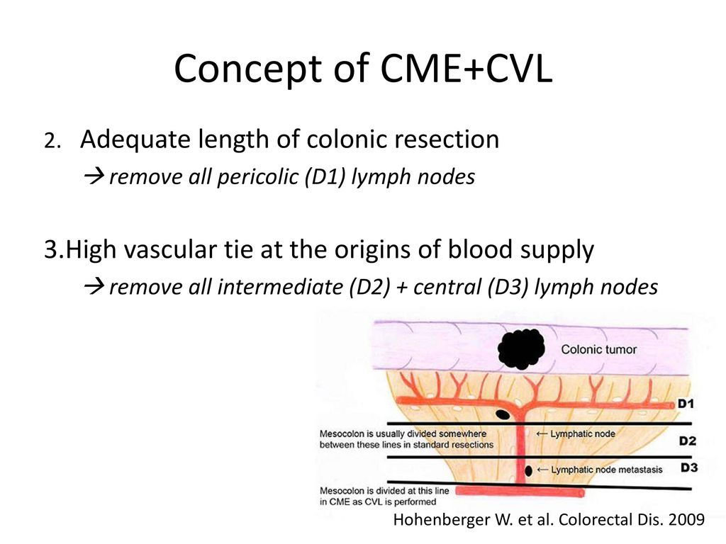 Concept of CME+CVL High vascular tie at the origins of blood supply