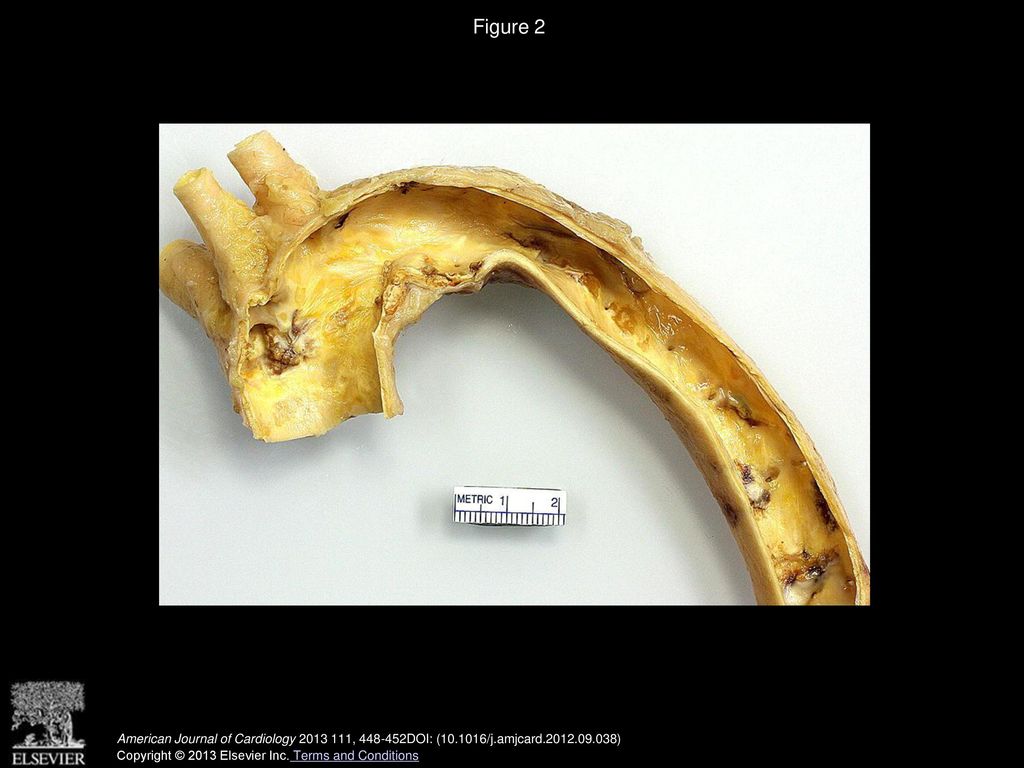Figure 2 Case 1. Aortic arch and descending thoracic aorta showing focal but fairly heavy calcific deposits.