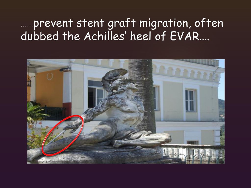 ……prevent stent graft migration, often dubbed the Achilles’ heel of EVAR….