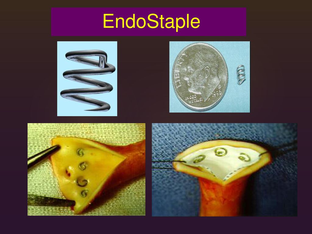 EndoStaple