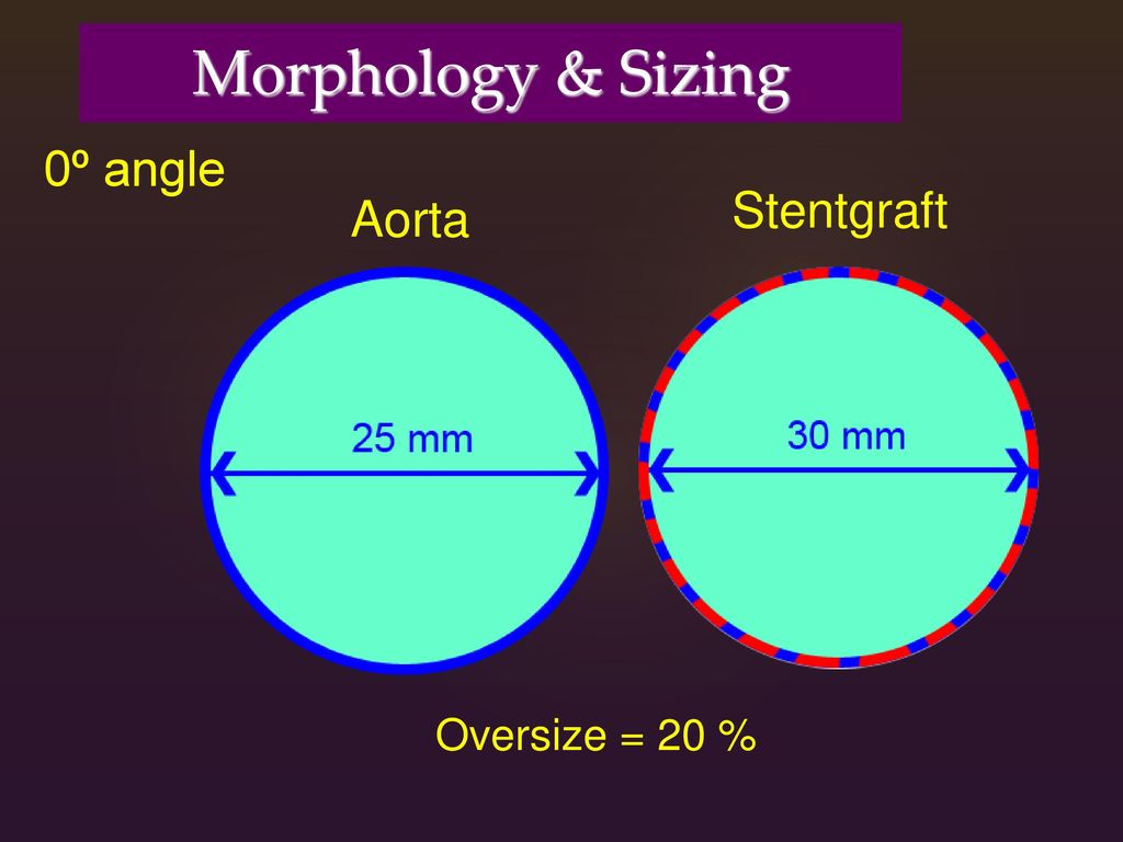 Morphology & Sizing 0º angle Stentgraft Aorta Oversize = 20 %
