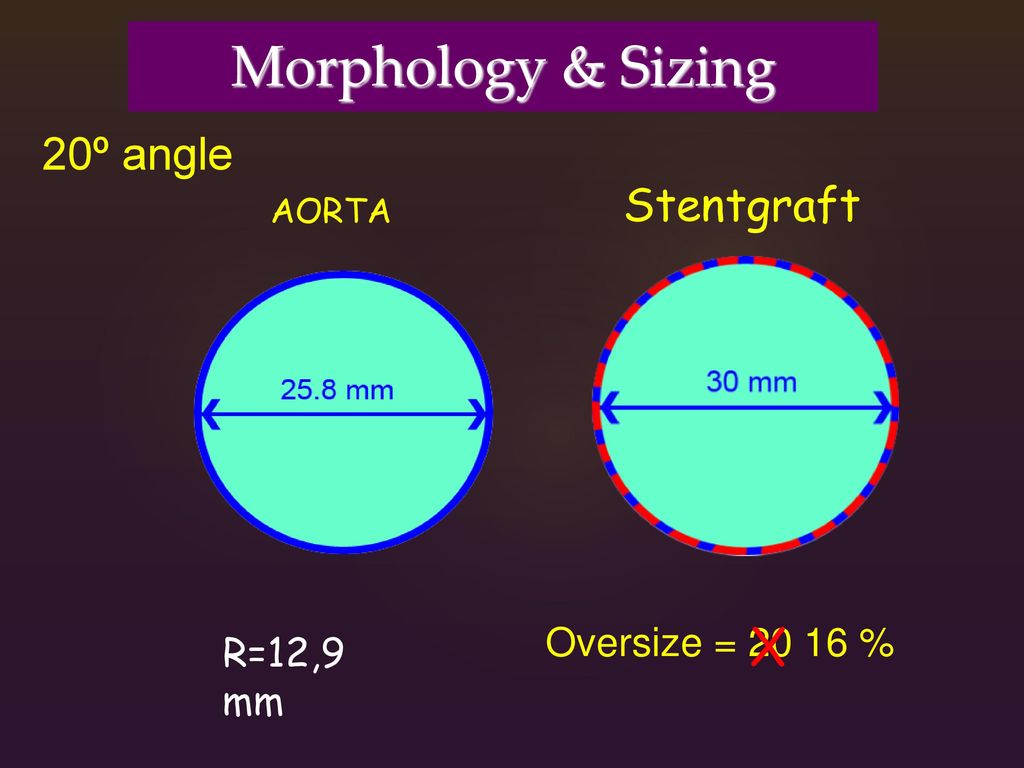 Morphology & Sizing X 20º angle Stentgraft Oversize = %