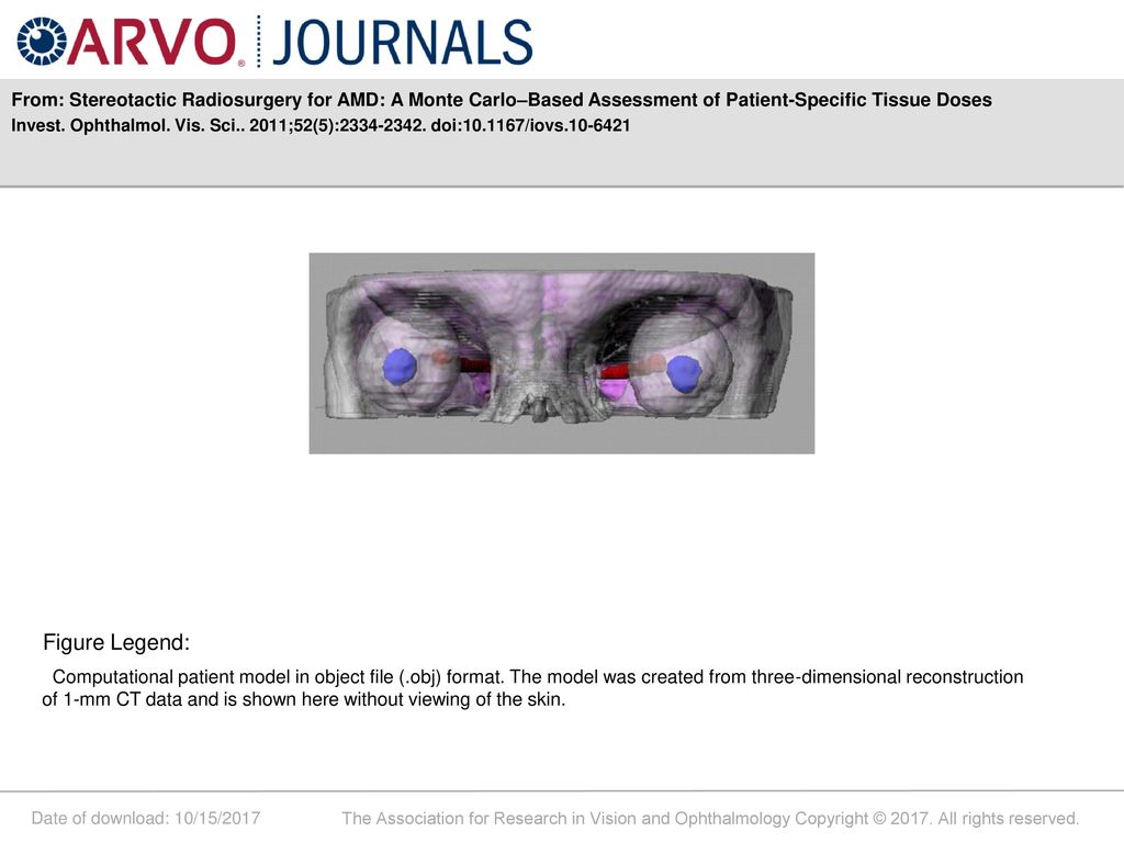 From: Stereotactic Radiosurgery for AMD: A Monte Carlo–Based Assessment of Patient-Specific Tissue Doses