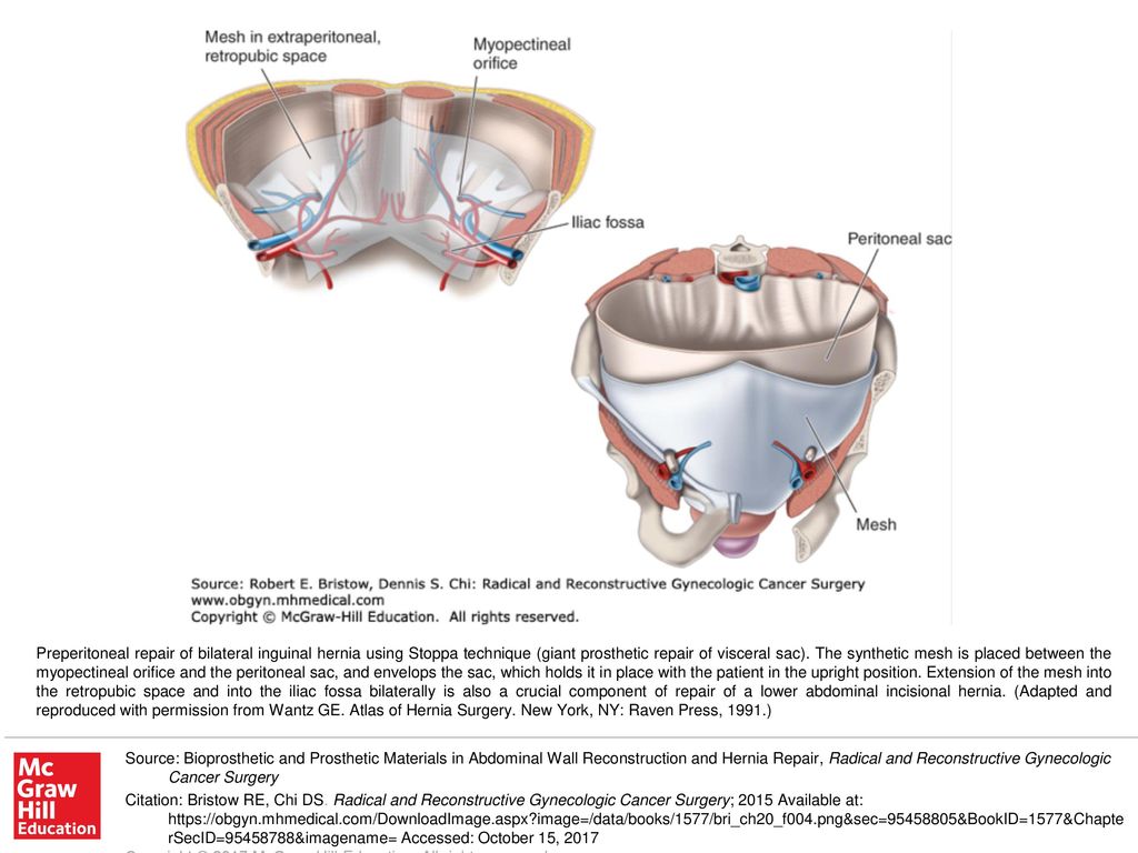 Preperitoneal repair of bilateral inguinal hernia using Stoppa ...