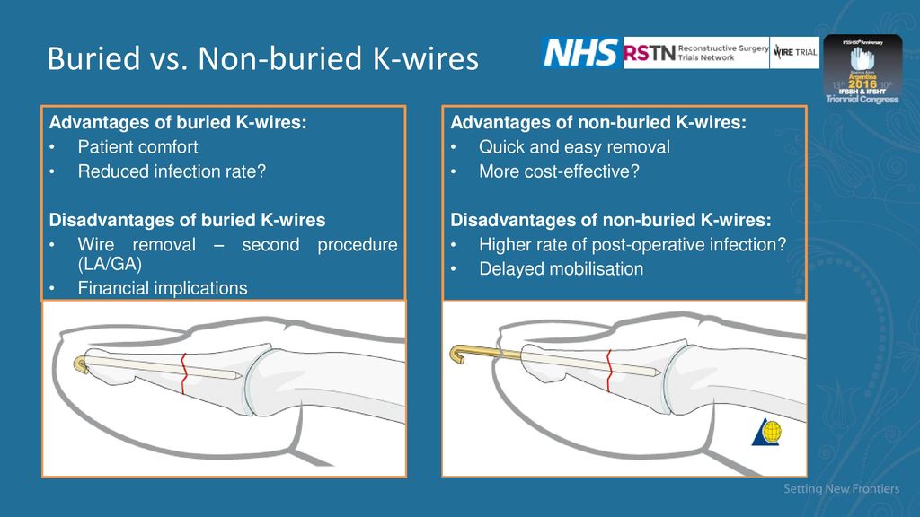 Kids Health Information : Kirschner wires (K-wires)