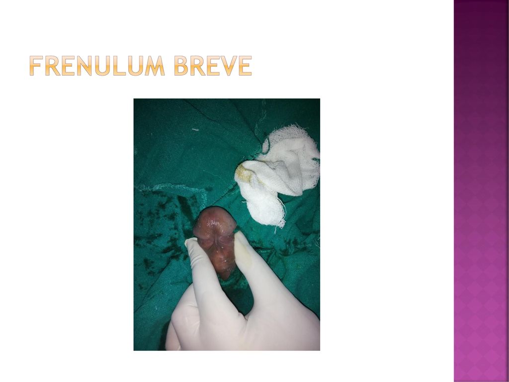 Operation frenulum kosten breve Penis Frenulectomy.