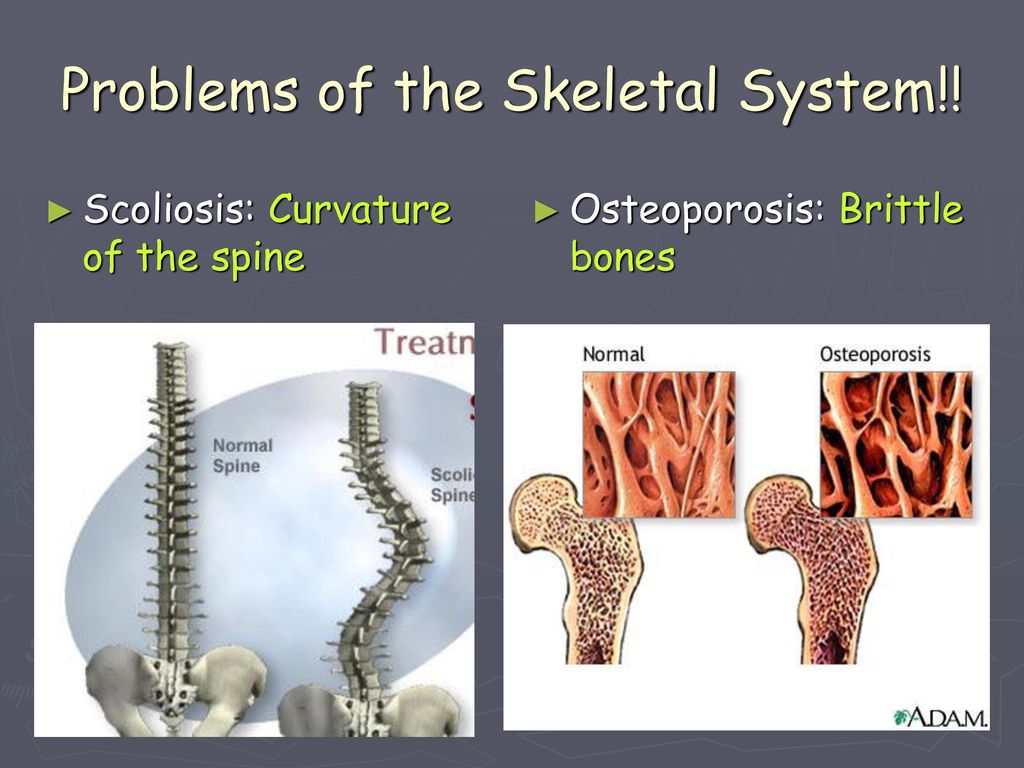 Brittle bones. Skeletal System презентация. Скелет презентации POWERPOINT. Curvatureof the Spine. Skeletal System ppt.