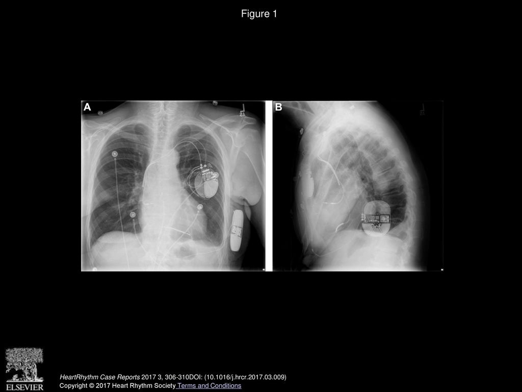 Figure 1 Anterior-posterior (A) and lateral (B) view chest radiographs following subcutaneous implantable cardioverter-defibrillator implantation.