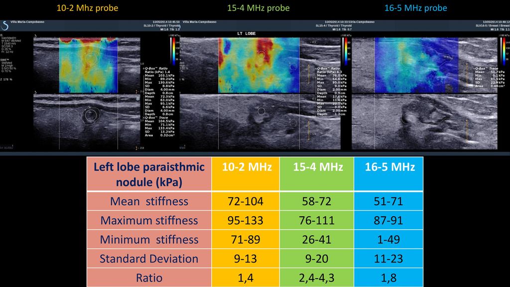 A small thyroid papillary cancer The role of Shear Wave Elastography ...