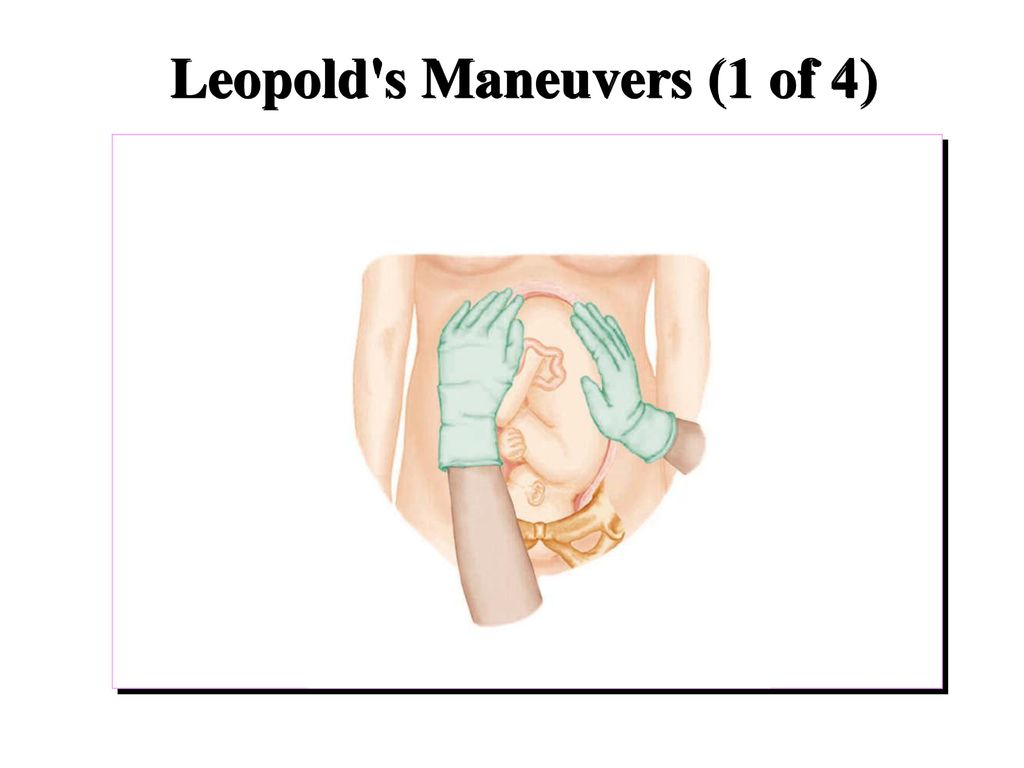 Leopold s Maneuvers (1 of 4)