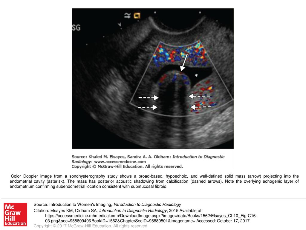 Color Doppler Image From A Sonohysterography Study Shows A Broad Based Hypoechoic And Well Defined Solid Mass Arrow Projecting Into The Endometrial Ppt Download Color Doppler Image From A Sonohysterography Study Shows A Broad Based Hypoechoic And Well Defined Solid Mass Arrow Projecting Into The Endometrial Ppt Download