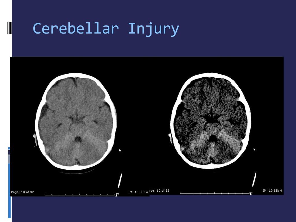 Cerebellar Injury