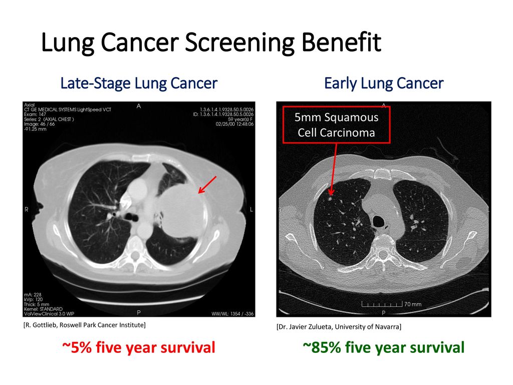 Lung Cancer Screening Benefit