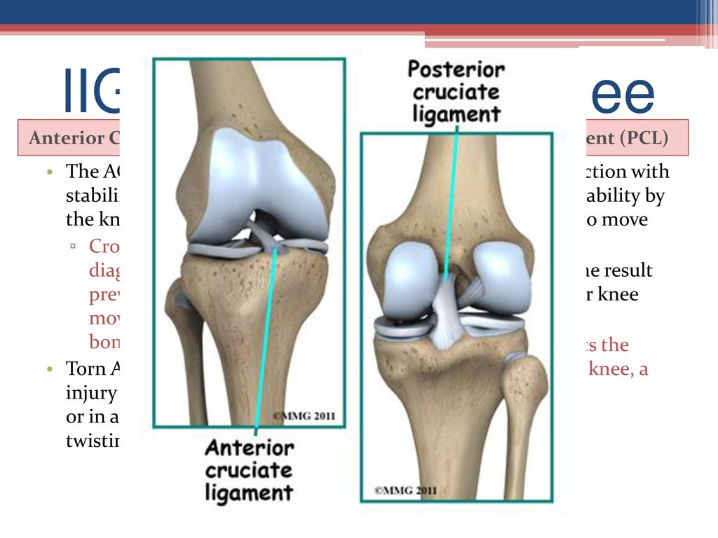 Полный разрыв передней крестообразной. Перерастяжение связок коленного сустава. ПКС (передняя крестообразная связка). ПКС связок коленного сустава. ПКС коленного сустава анатомия.