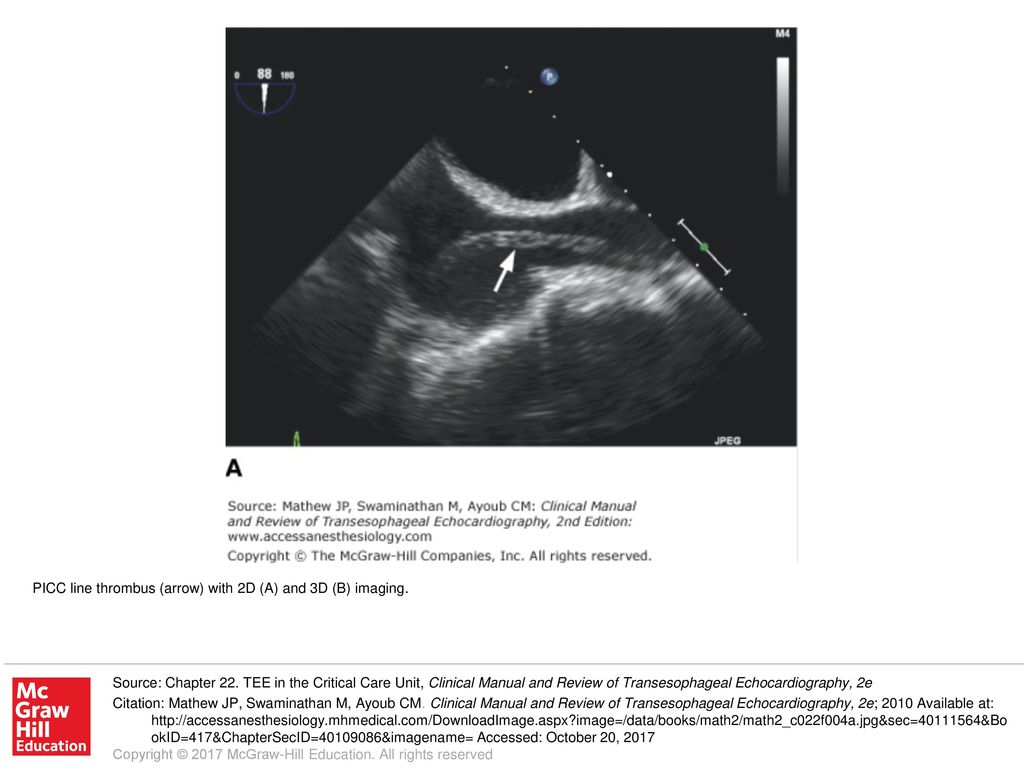 Picc Line Thrombus Arrow With 2d A And 3d B Imaging Ppt Download Picc Line Thrombus Arrow With 2d A And 3d B Imaging Ppt Download