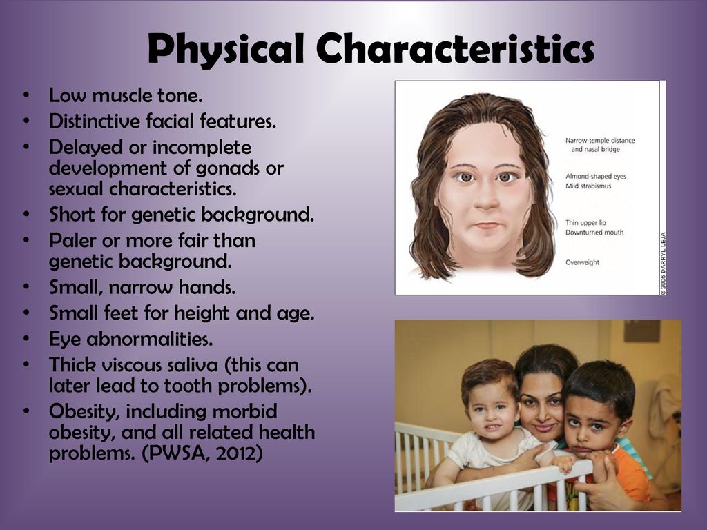 The Disability with a Dual Nature: Prader-Willi Syndrome in EI and ECSE By  Brittney Anne Fitts. - ppt download