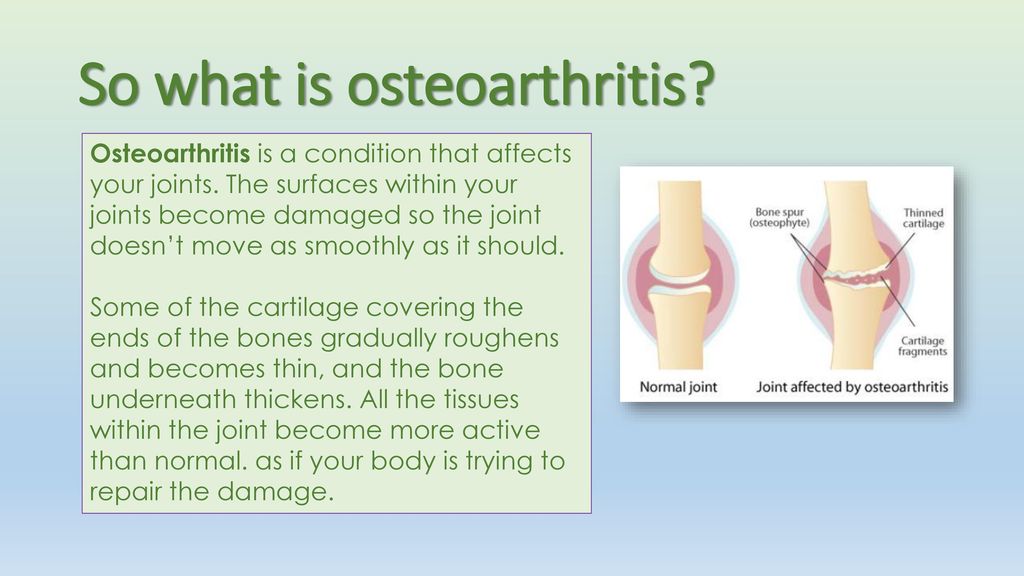 Bokaízület osteoarthritis gyógyszeres kezelése
