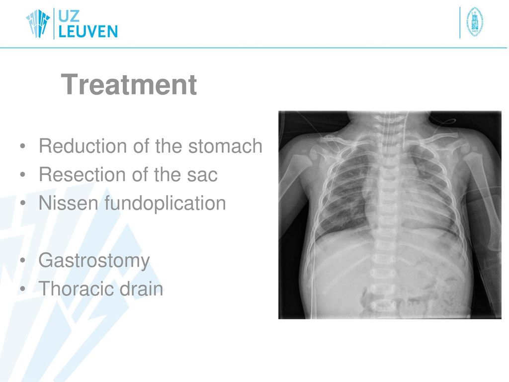 Treatment Reduction of the stomach Resection of the sac