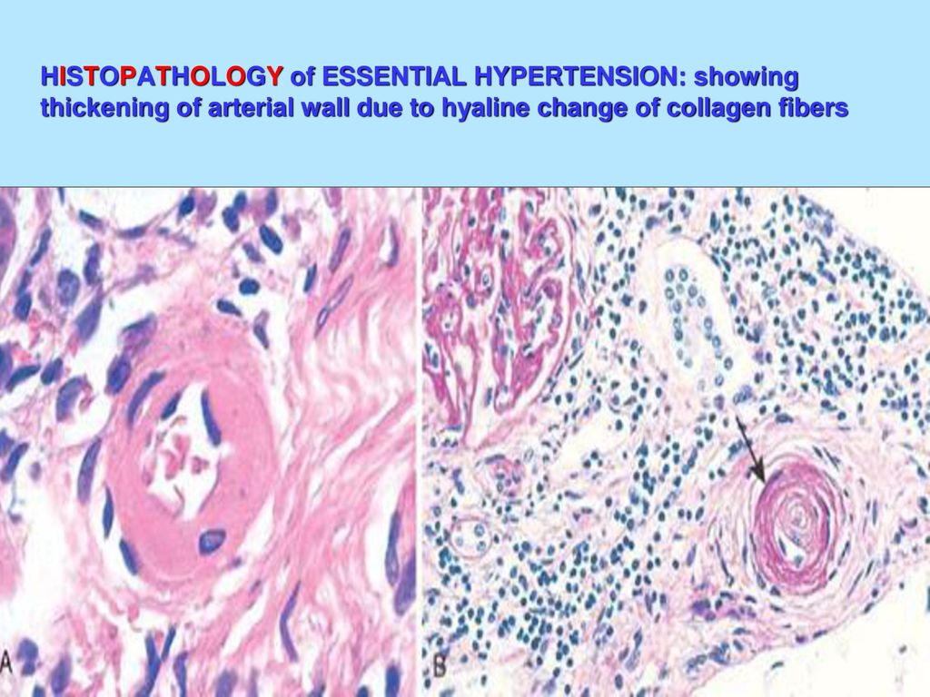 HISTOPATHOLOGY of ESSENTIAL HYPERTENSION: showing thickening of arterial wall due to hyaline change of collagen fibers