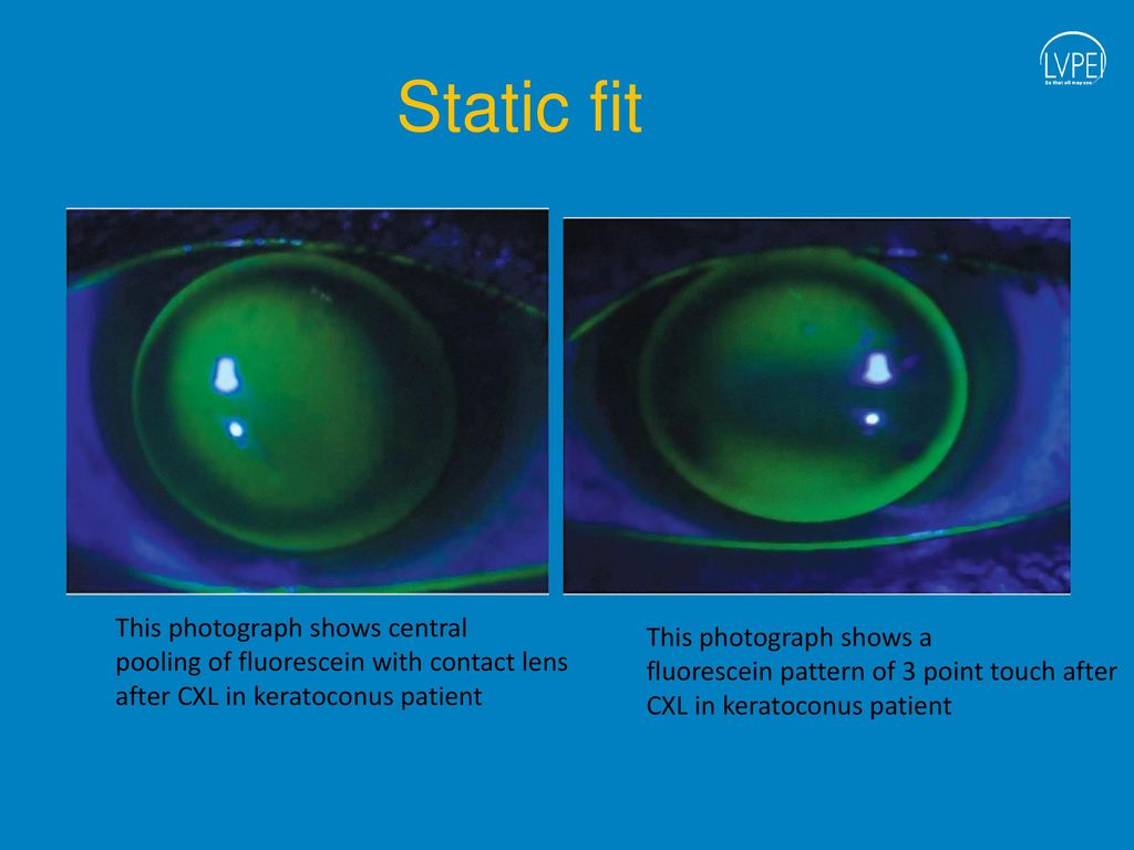 17100 Contact Lens Fitting After Corneal Cxl Ppt Download