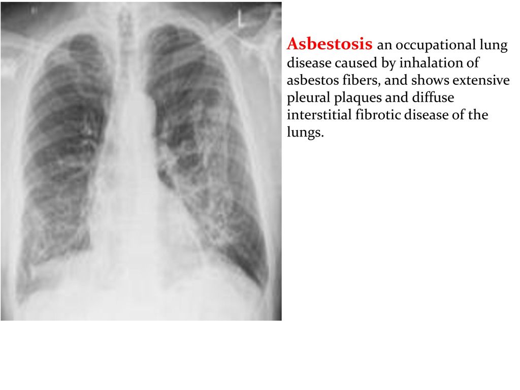 can bronchitis lead to emphysema