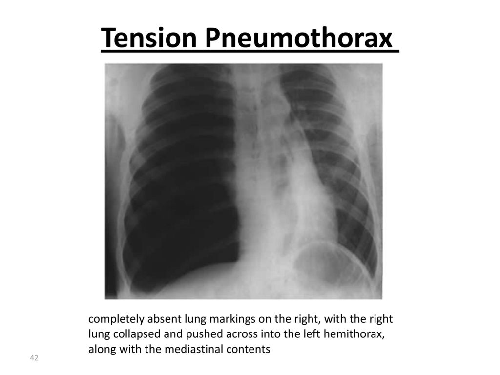 Rhumatoid arthritis. - ppt download