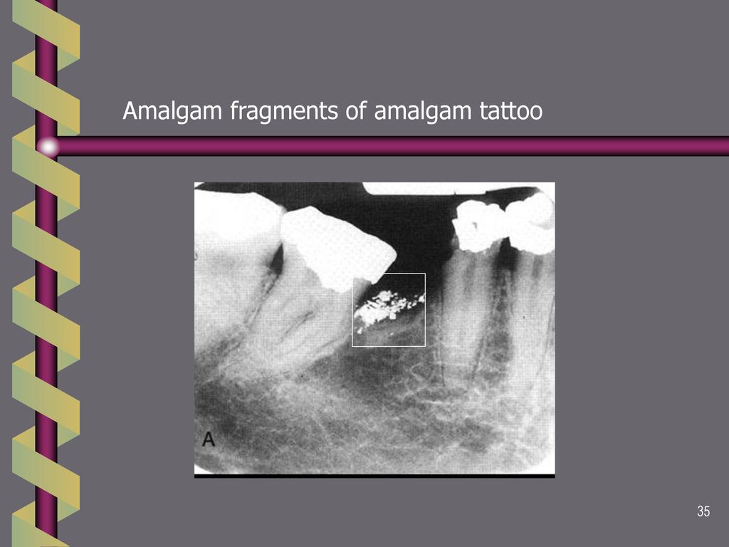 Amalgam_Tattoo #Synonyms 🔺Amalgam... - Treponema Denticola | Facebook