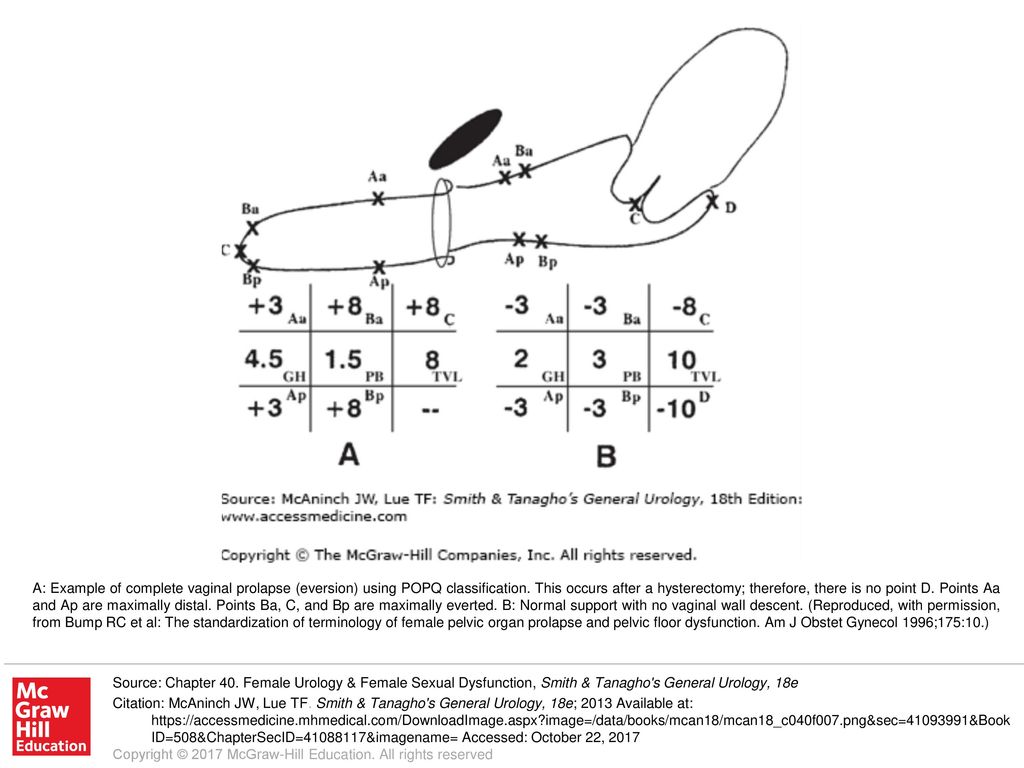 A Example Of Complete Vaginal Prolapse Eversion Using Popq Classification This Occurs After A Hysterectomy Therefore There Is No Point D Points Ppt Download