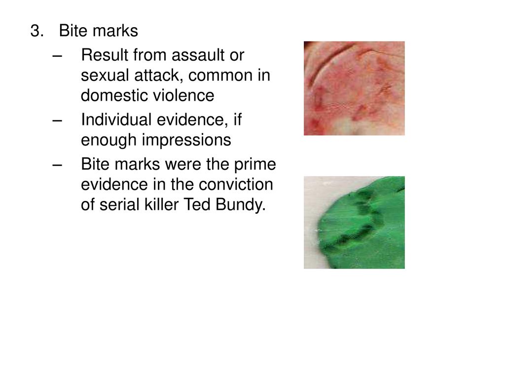 Bite marks Result from assault or sexual attack, common in domestic violence. Individual evidence, if enough impressions.