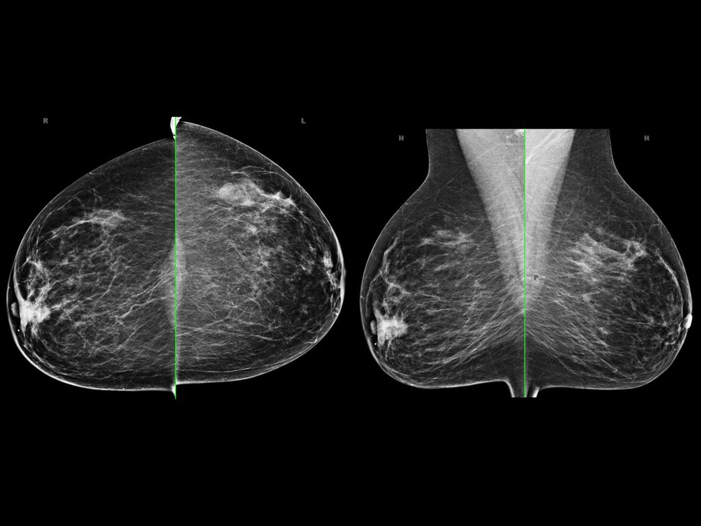 Challenge In Breast Imaging Volumetric Analysis Of Tumor Breast