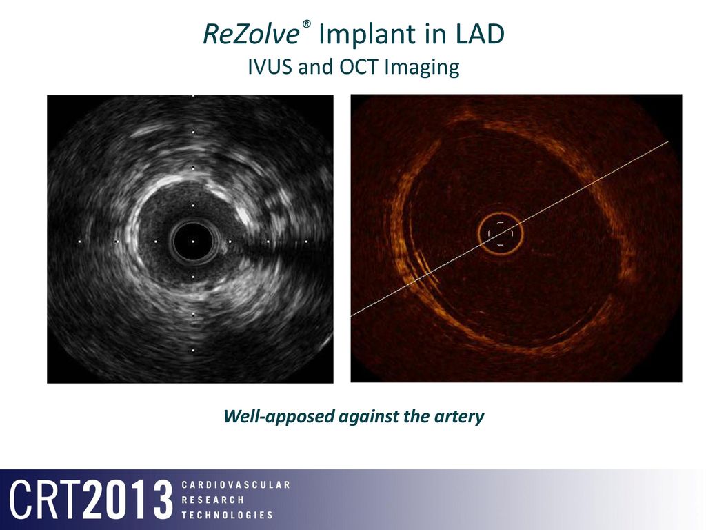 ReZolve® Implant in LAD IVUS and OCT Imaging