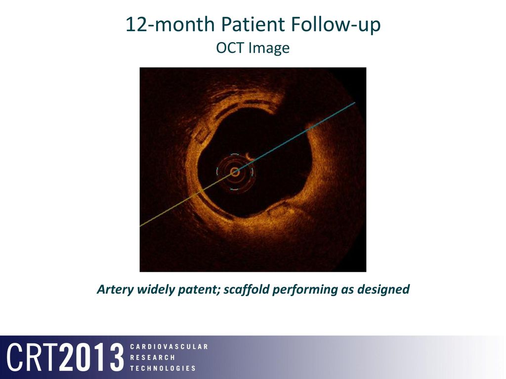 12-month Patient Follow-up OCT Image