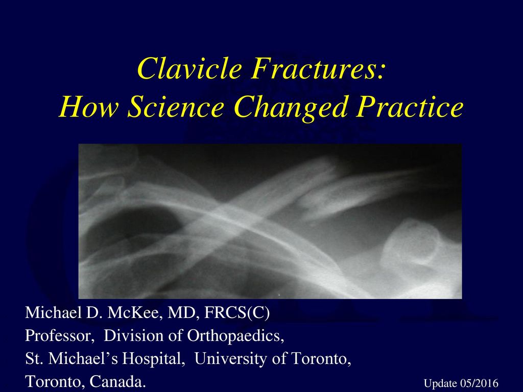 Clavicle Fractures: How Science Changed Practice