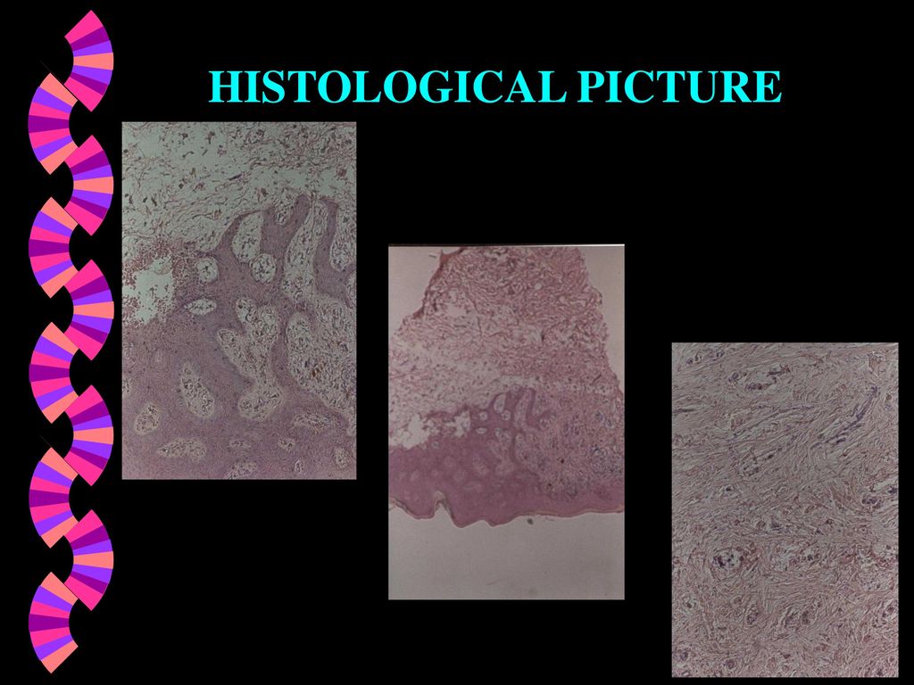 DISCOID LUPUS ERYTHEMATOSUS IN PALATAL MUCOSA - ppt download