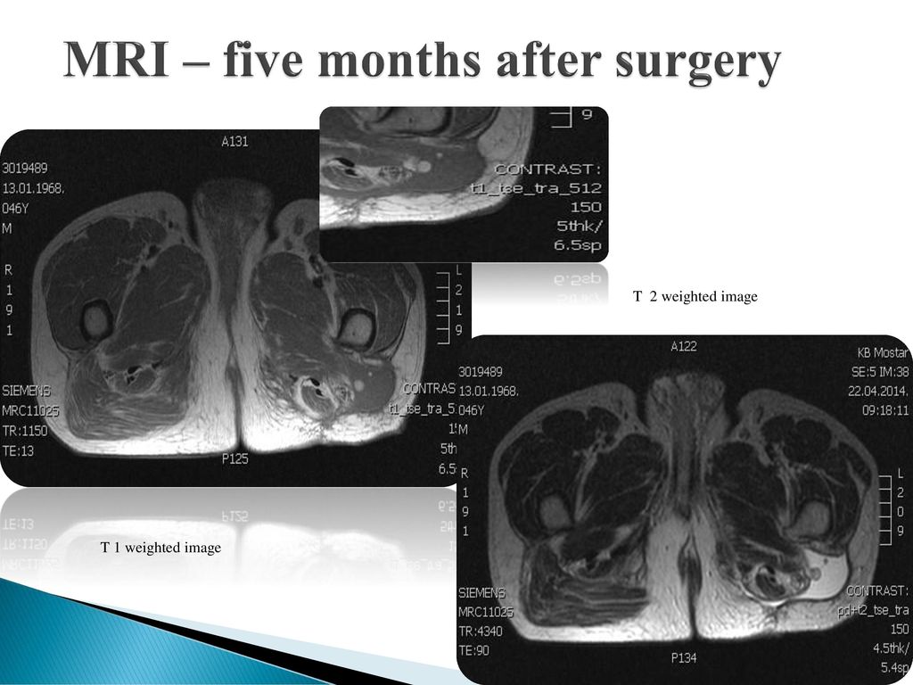 A full diagnostic followup in a rare case of myxoid liposarcoma - ppt ...