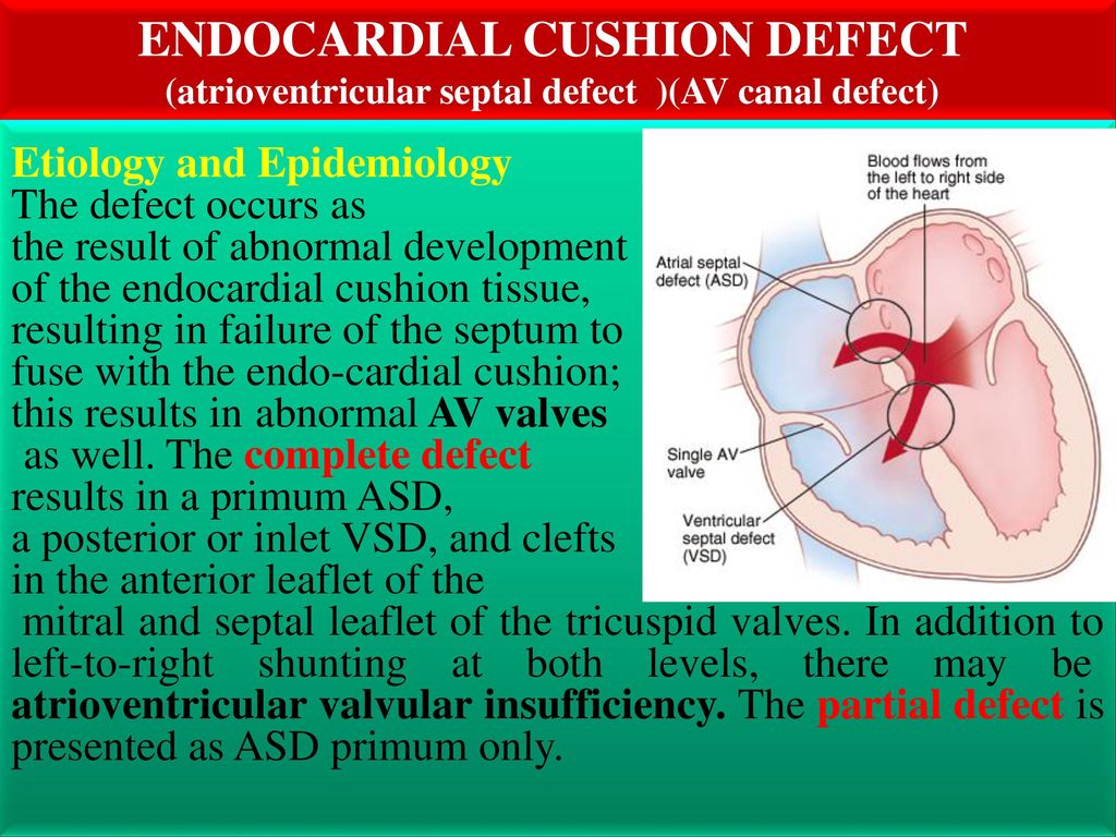 Endocardial Cushion Defect