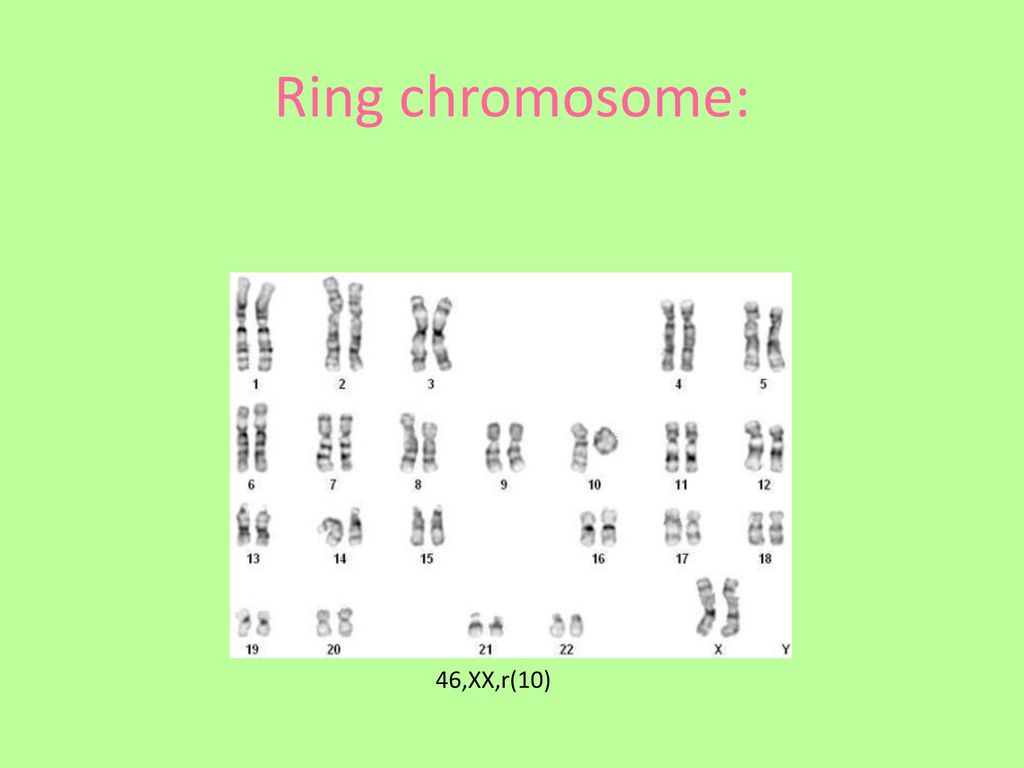 Small supernumerary marker chromosome - Wikipedia