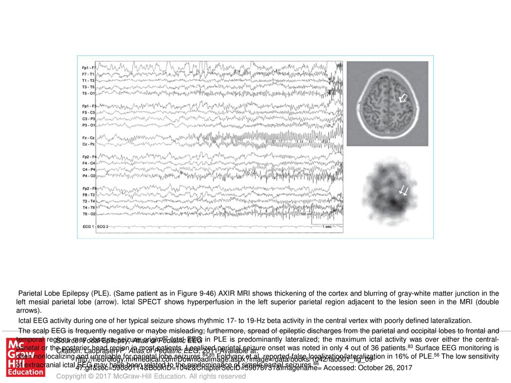 The scalp EEG is frequently negative or maybe misleading; furthermore ...