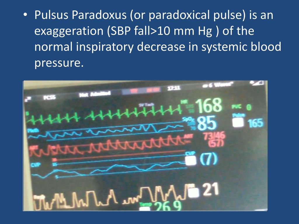 Pulsus Paradoxus (or paradoxical pulse) is an exaggeration (SBP fall>10 mm Hg ) of the normal inspiratory decrease in systemic blood pressure.