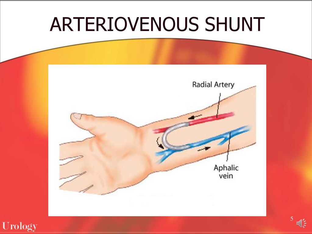 Difference Between Fistula and Shunt