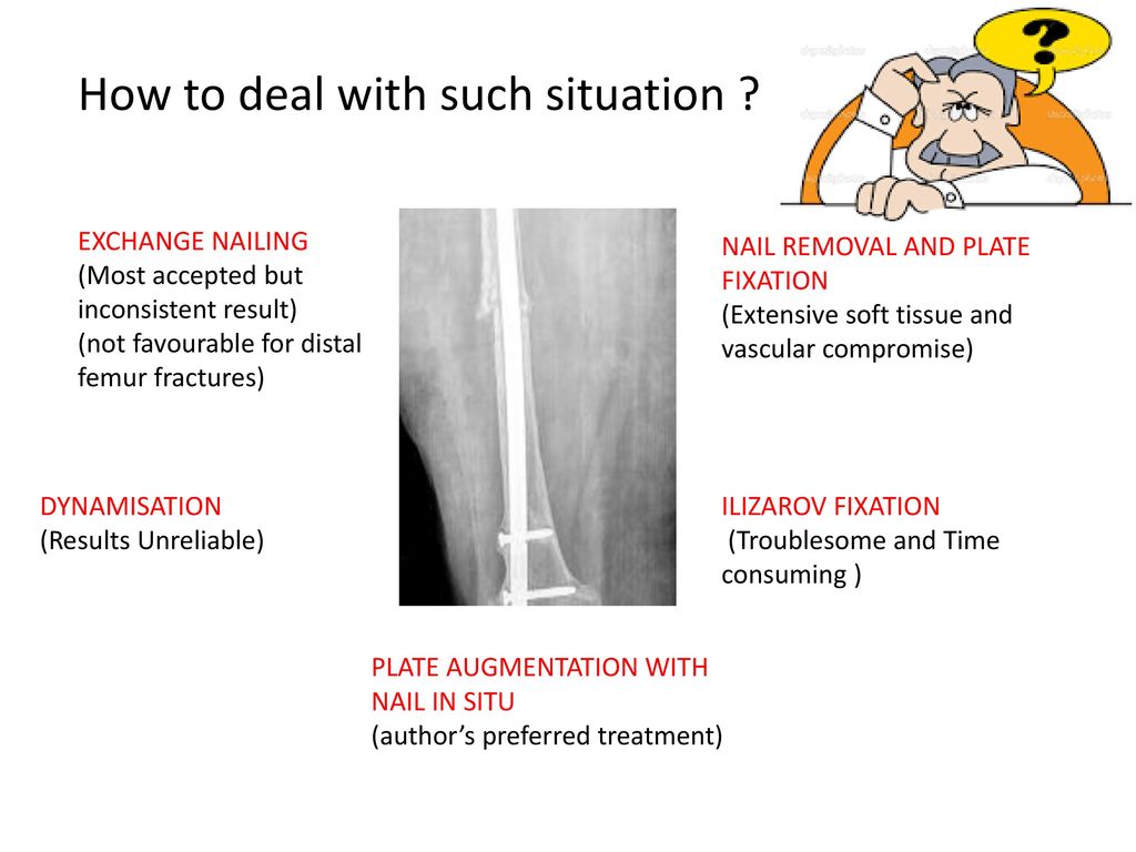 Is removal of a nail and re-osteosynthesis necessary for all un-united  femoral shaft fracture? (Abstract no:43413) Raju Vaishya, Amit Kumar  Agarwal. - ppt download