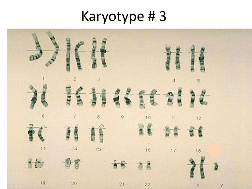 Xxy хромосома. Кариотип Клайнфельтера. Кариотип при синдроме Клайнфельтера. Синдром Клайнфельтера кариотип.