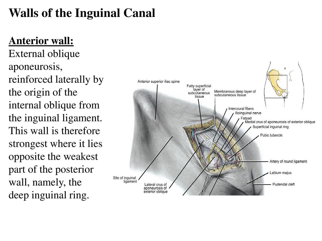 An inguinal hernia with the small intestine, internal inguinal ring,  external inguinal ring, pubic bone, penis, spermatic cord, and testes  labeled - Media Asset - NIDDK